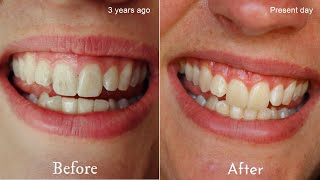 DIY Remineralising Toothpaste  Restore tooth enamel naturally [upl. by Mapel]