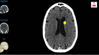 Ct brain 01  normal anatomy ventricles amp subarachnoid cisterns [upl. by Hibbitts803]