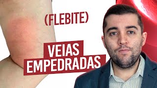 Atualização sobre os riscos da flebite e sua relação com trombose e embolia Como tratar e prevenir [upl. by Benji]