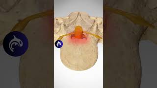 See how Lumbar Stenosis affects the Spine  3D Animation lumbarspinalstenosis backpain backpain [upl. by Hgielac]