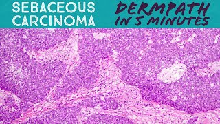 Sebaceous Carcinoma Dermpath in 5 Minutes  pathology dermatology dermatopathology skin cancer [upl. by Sue]