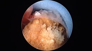 PCNL keyhole technique for kidney stone removal  दूरबीन द्वारा गुर्दे की पथरी का ऑपरेशन [upl. by Enaols]