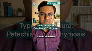 Types of Purpura Petechiae VS Ecchymosis for USMLE NEET PG NCLEX INICET [upl. by Neersin]