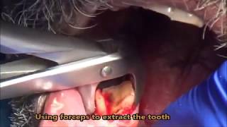 Severely attrited lower first molar extraction [upl. by Eserahs]