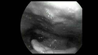 Video laryngoscopy showing Intra Epithelial Cell Carcinoma of Larynx [upl. by Angelique]