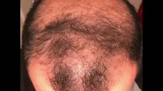 6 months using minoxidil  Rogaine 5 Before amp After results [upl. by Eleda389]