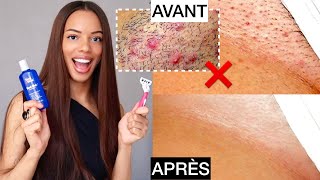 SOS Épilation du Maillot ANTI Boutons Poils Incarnés amp Peau Foncée  ConseilsProduits Miracles [upl. by Anaidiriv122]