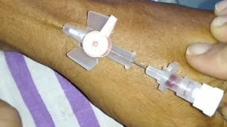 Peripheral IV insertion  Correct Angle  IV cannulation drtusarofficial [upl. by Roti]