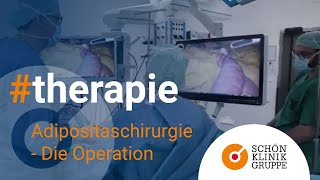 Adipositaschirurgie  Die Operation  Schön Klinik Hamburg Eilbek [upl. by Ennobe]