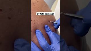 How Satisfying is this DPOW removal dpow shorts [upl. by Rebbecca]