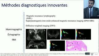 04 Les innovations dans la prise en charge chirurgicale de l’aisselle [upl. by Ak]