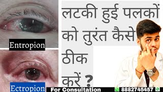 What is entropion and ectropion Dropping eyelid  Can entropion be treated without surgery [upl. by Llerut856]