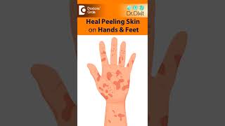 SKIN PEELING from Hand amp FeetIs it Eczema PsoriasisFungusDrRasya DixitDoctors Circle shorts [upl. by Calvinna]