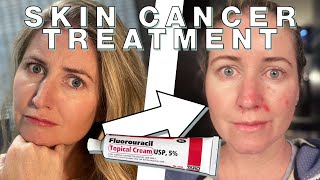 Chantelles Fluorouracil Skin Cancer Treatment  Skin Deep [upl. by Remot356]