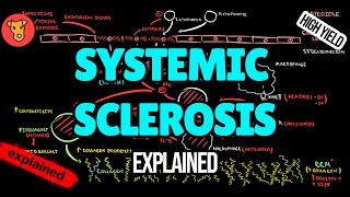 SCLERODERMA Systemic sclerosis Pathogenesis Diagnostic criteria Classification EULAR Treatment [upl. by Einahteb495]