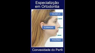 Convexidade Parcial do Perfil [upl. by Anuait991]