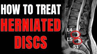 Herniated Disc at L4L5 or L5S1 Simple Tips to Relieve Back Pain [upl. by Laith]