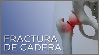 Fractura de cadera causas síntomas y tratamiento [upl. by Mcclish]