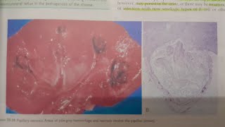 Acute Pyelonephritis  SPECIAL PATHOLOGY [upl. by Koehler]