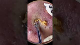 Ultimate Blackhead Removal amp Pimple Popping 🔴 71 [upl. by Asamot772]