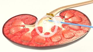 UROMED Balloon Catheter Set NEPHROquick®  Percutaneous nephrostomy catheter for renal drainage [upl. by Lemmy]