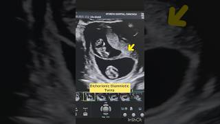 “Key Ultrasound Findings in Dichorionic Diamniotic Twins” [upl. by Woodward]