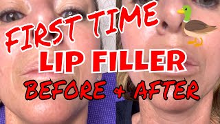 FIRST TIME LIP FILLER BEFORE AND AFTER JUVEDERM [upl. by Haym569]