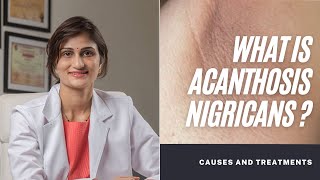 What is Acanthosis Nigricans or Hyperpigmentation [upl. by Gaal684]