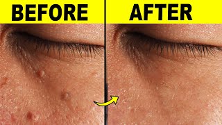 9 Effective Ways To Remove Skin Tags At Home [upl. by Katzman211]