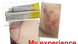 Contractubex gelbest gel for acne and scarsWith my acne pics must watch👍 [upl. by Maximilianus]