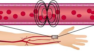 A new method for tracking endothelial dysfunction and heart disease risk in patients with diabetes [upl. by Dallis36]