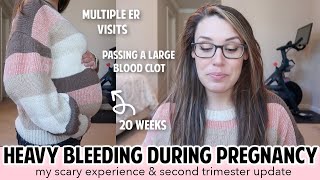 BLEEDING IN PREGNANCY  FIRST amp SECOND TRIMESTER BLEEDING  SUBCHORIONIC HEMATOMA PLACENTA PREVIA [upl. by Lita150]