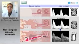 Preeclampsia cribado y prevención [upl. by Chandra621]