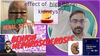 NEPHROSCLEROSISEFFECT OF HYPERTENSION ON KIDNEY PART 21  NEPHROLOGY [upl. by Elletnuahs681]