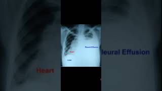 Left Sided Pleural Effusion with Dextroposition of HeartAwerenes of All [upl. by Eimmas]