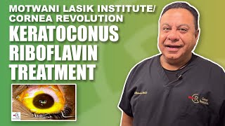 Keratoconus Vision Correction with Riboflavin Treatment [upl. by Garbers458]