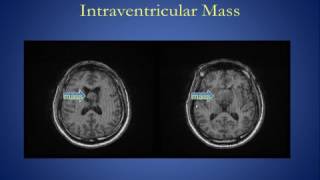 Intracranial Mass Lesions Version 1 0 [upl. by Smith]