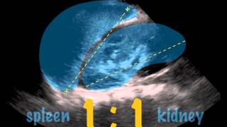 SonoKids Tutorials  ScanTip  SPLENOMEGALY [upl. by Odell]