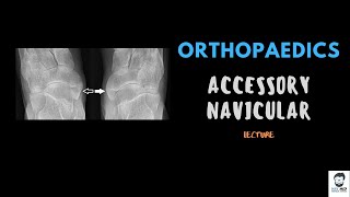 Accessory navicular Bone  Orthopaedics  Detailed Lecture [upl. by Gnehp976]