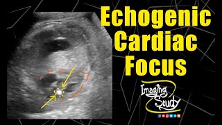 Fetal Echogenic Cardiac Focus  Ultrasound  Anomaly  Case 158 [upl. by Teryn]