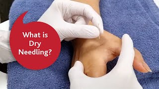 What is dry needling [upl. by Luigi]