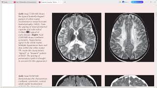 PAEDIATRIC NEURORADIOLOGY DIAGNOSTIC IMAGING [upl. by Ykcul]