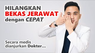 Cara Menghilangkan BEKAS JERAWAT PIH secara Medis [upl. by Gavrilla894]