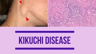 Kikuchi disease  Factors  Clinical features  Diagnosis  histopathology  Management [upl. by Ayocal599]