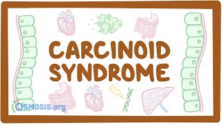 Carcinoid Syndrome  causes symptoms diagnosis treatment pathology [upl. by Anela]