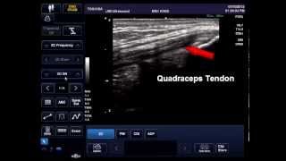 Anisotropy Ultrasound Artifact Demonstration  United Medical Instruments [upl. by Eissak]