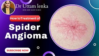 Spider Angioma cause and Treatment radiating blood vessels on skin  Dr Uttam Kumar Lenka [upl. by Ecnadnak]