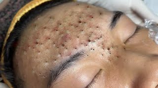 Big Cystic Acne Blackheads Extraction Blackheads amp Milia Whiteheads Removal Pimple Popping  316 [upl. by Michelle283]