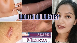 Mederma Scars Gel Worth or Waste Burn scarschiken pox scarscut marksacne scarsstretch marks [upl. by Ddot772]