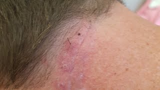 Overgrown Suture Removal On Neck [upl. by Lleret79]